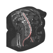 Result image: CSR applied to a medical volume data set of the bifurcation of the human abdominal aorta.